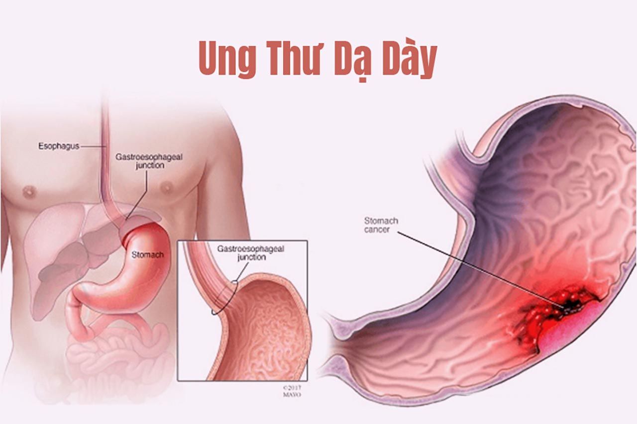 Ung thư dạ dày và loét dạ dày: Những điểm khác biệt 2 bệnh