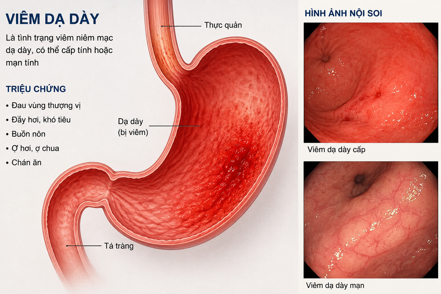 Bệnh viêm dạ dày kiêng gì?